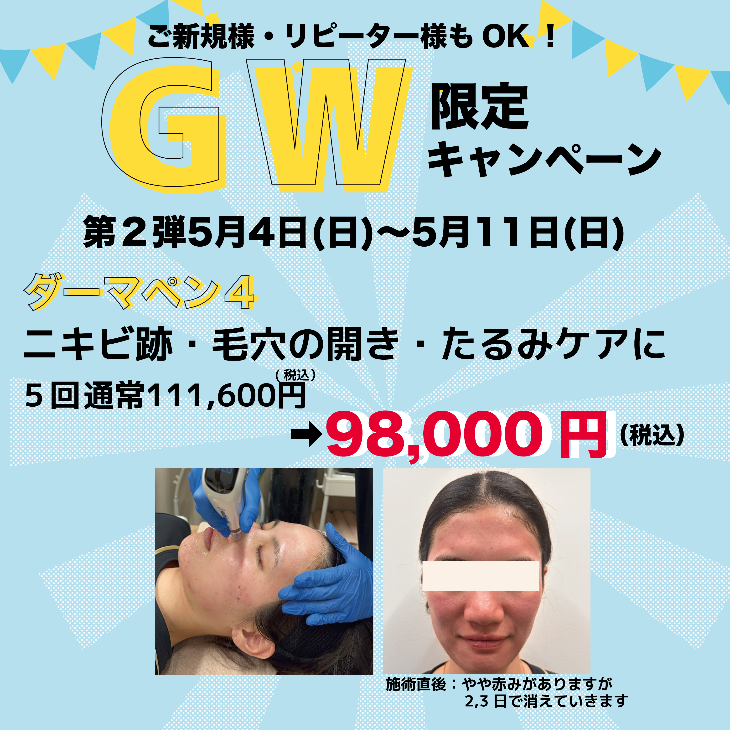 【GW限定キャンペーン】第2弾！！ダーマペン4を期間限定でお得に！