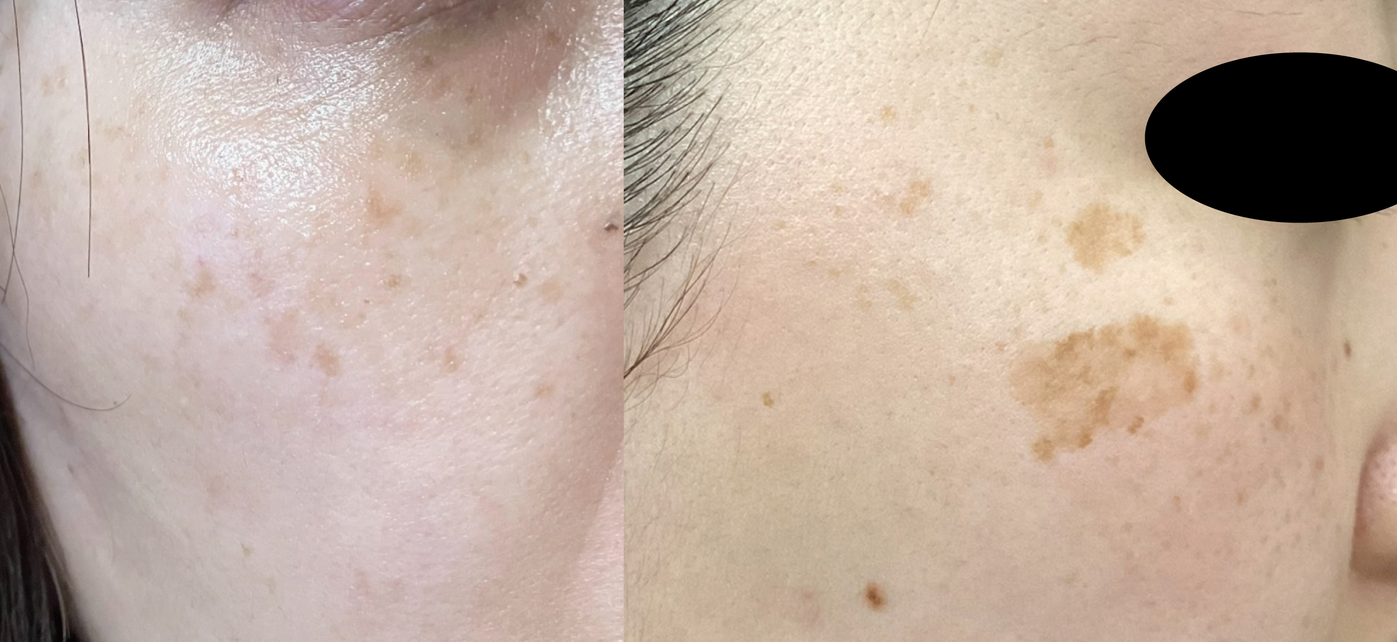 シミ肝斑の症例