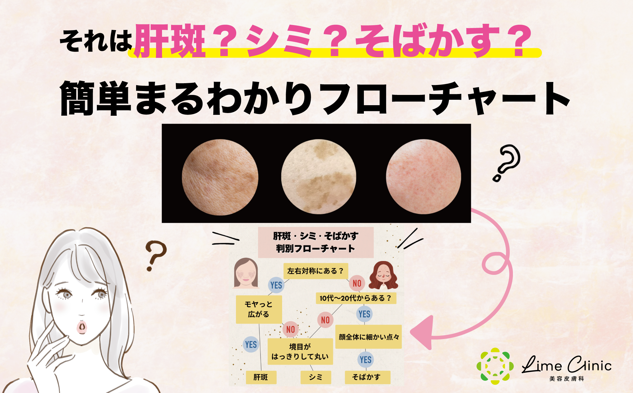 「それは肝斑？シミ？そばかす？」簡単フローチャートでチェック！
